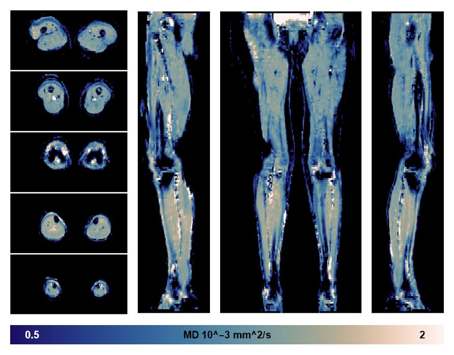 IVIM corrected whole leg muscle mean diffusivity obtained from diffusion tensor imaging.